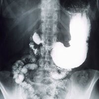 Картинка желудка в рентгене